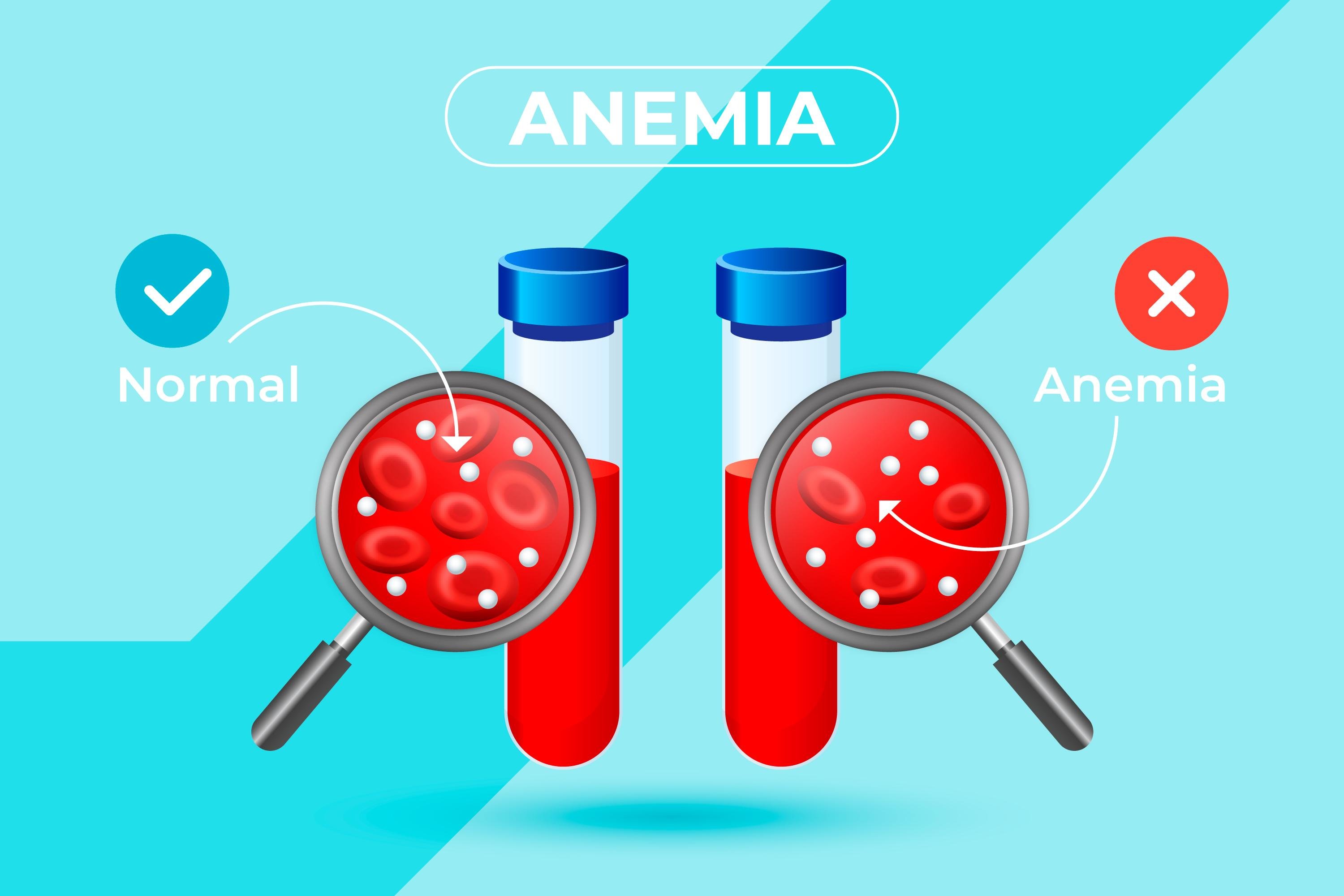 Anemia