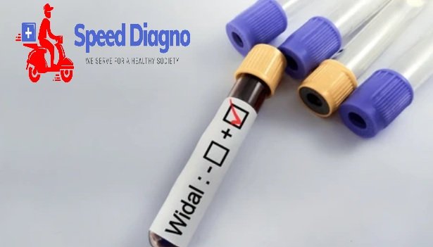 WIDAL TEST - Slide