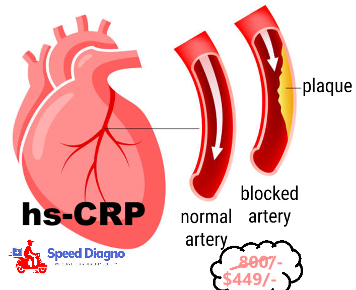 hs CRP (High Sensitive C Reactive Protein)