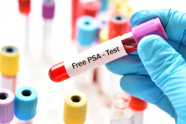 FREE PSA (PROSTATE SPECIFIC ANTIGEN)
