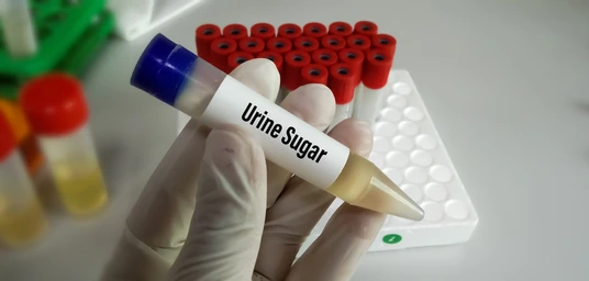 URINE ACETONE-FASTING
