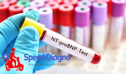 N-TERMINAL PRO B-TYPE NATRIURETIC PEPTIDE (NT-PRO BNP)