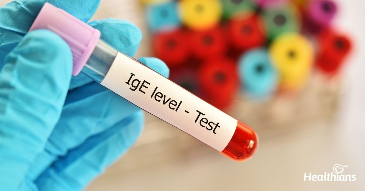 IMMUNOGLOBULIN E (IgE) - TOTAL