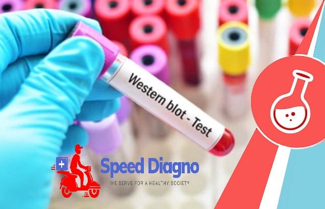 WESTERN BLOT TEST ( HIV )
