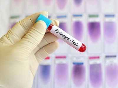 FIBRINOGEN DEGRADATION PRODUCT ( FDP )