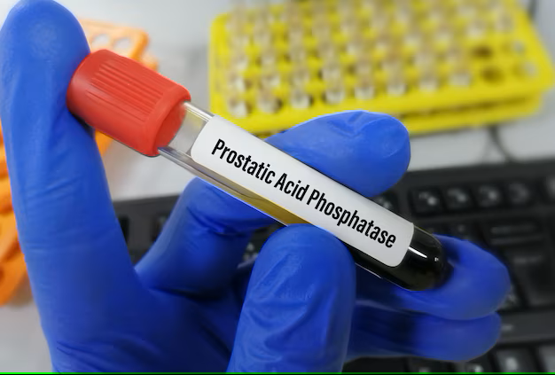 ACID PHOSPHOTASE - PROSTATIC FRACTION