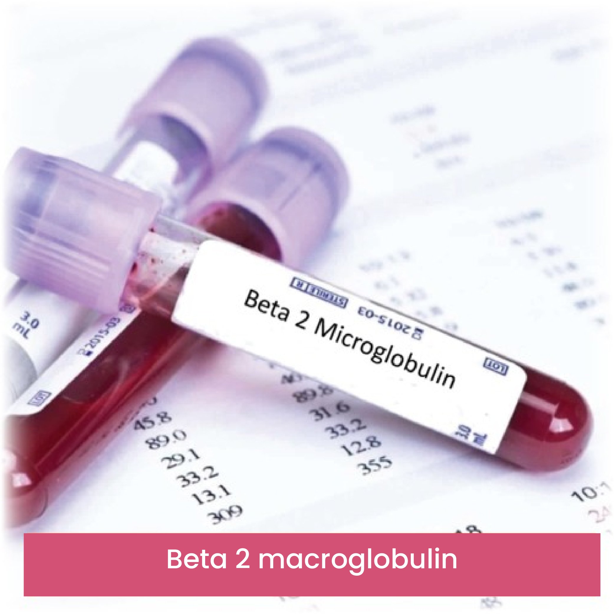BETA 2 MICROGLOBULIN