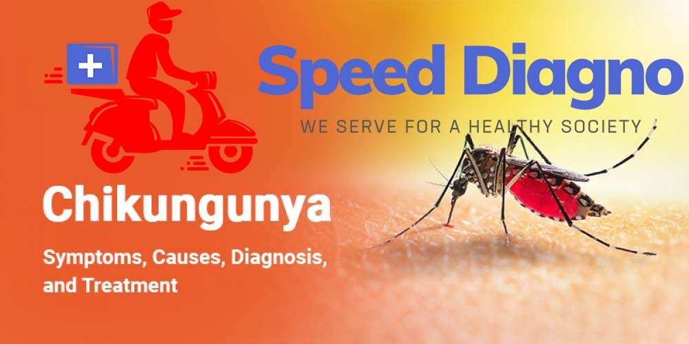 CHIKUNGUNYA ANTIBODIES IgM