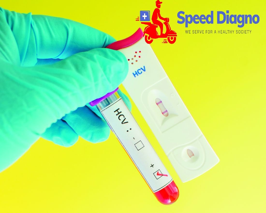 HEPATITIS C VIRUS ( HCV ) Card Test