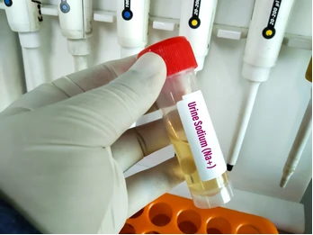 Urinary Sodium ( Na )