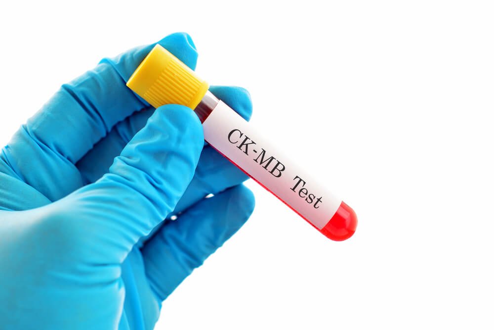 CK-MB (Creatine Kinase-MB)