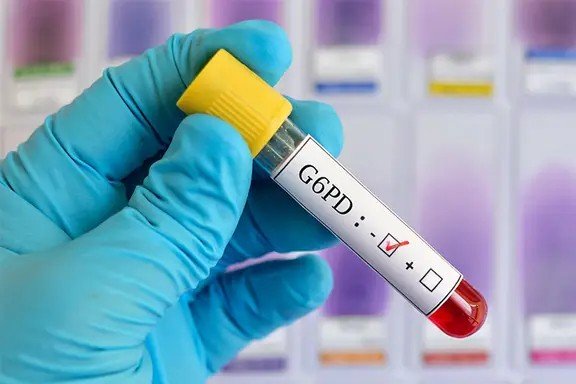 Glucose 6 Phosphate Dehydrogenase (G6PD Quantitative)