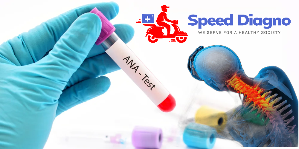 Antinuclear Antibody Blot(ANA BLOT)