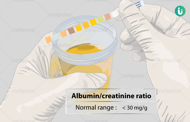URINE ALBUMIN CREATININE RATIO