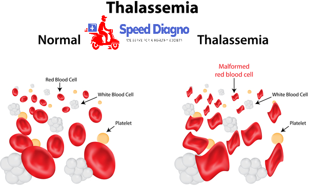 BETA THALASSEMIA (MUTATION ANALYSIS FOR ALL EXONS ON PERIPHERAL BLOOD)