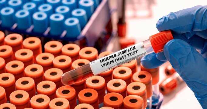 Herpes Simplex Virus (HSV) 1-IgM