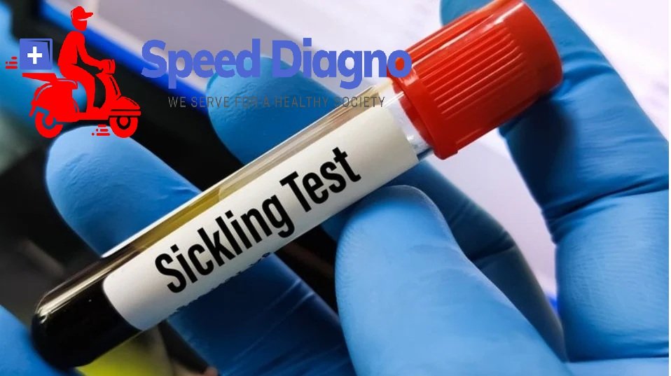 SICKLING TEST